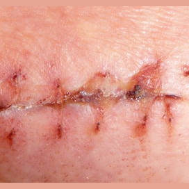 A scar 