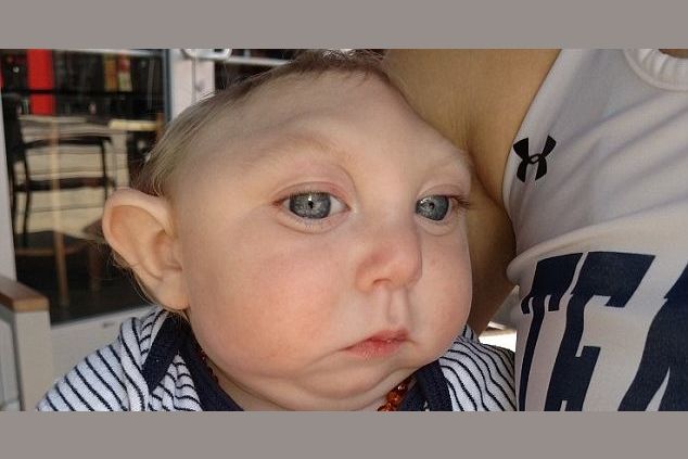 Florida Baby Boy Born Without Parts Of Skull And Brain Celebrates 1st ...