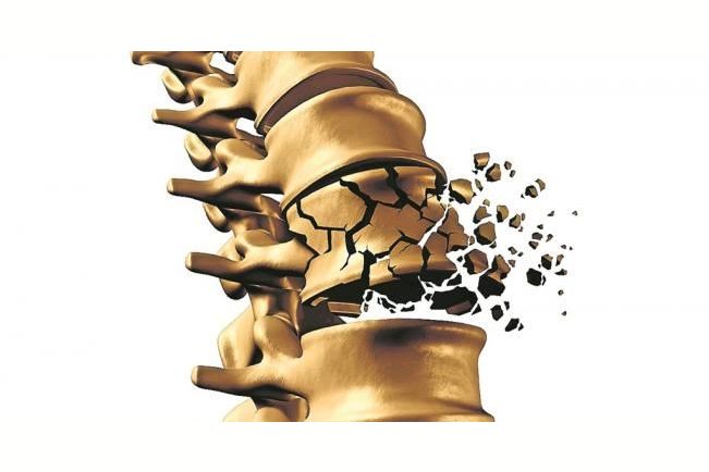 Виды перелома позвоночника. Чего нельзя делать при переломе и как ...
