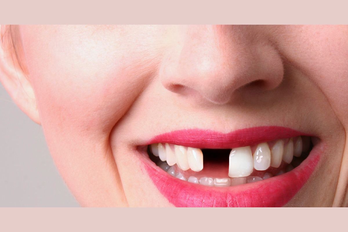 Сонник выпадение зубов без. Вставные зубы выпадают фото. Выпадают вставные зубы во сне к чему. Сон выпали вставные зубы. Может ли быть аллергия слизистой рта на вставные зубы фото.