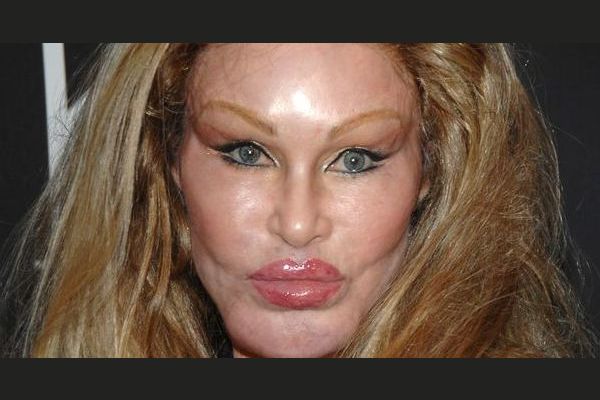 17 Most Extreme Celebrity Plastic Surgeries