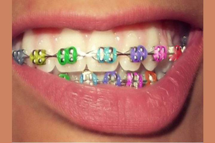 21 Struggles Anyone Who Had Braces As A Kid Will Remember Are you even getting braces?? 21 struggles anyone who had braces as a