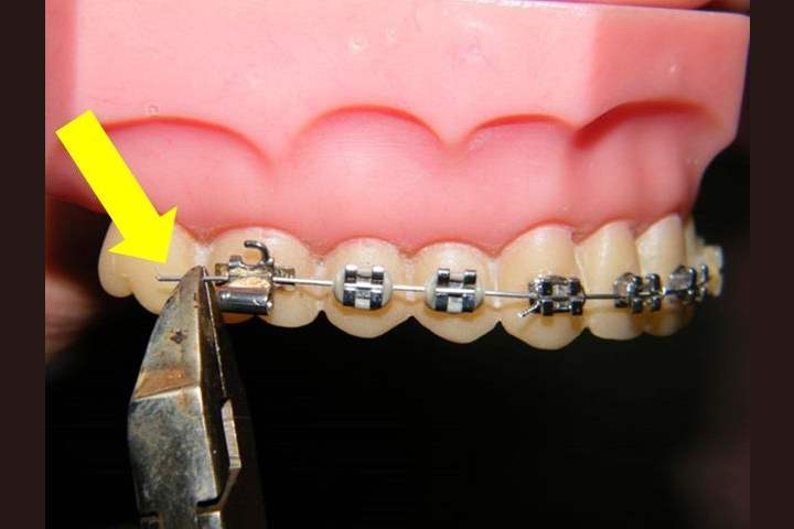 21 Struggles Anyone Who Had Braces As A Kid Will Remember We love colorful gadgets, so we often choose colored braces. 21 struggles anyone who had braces as a