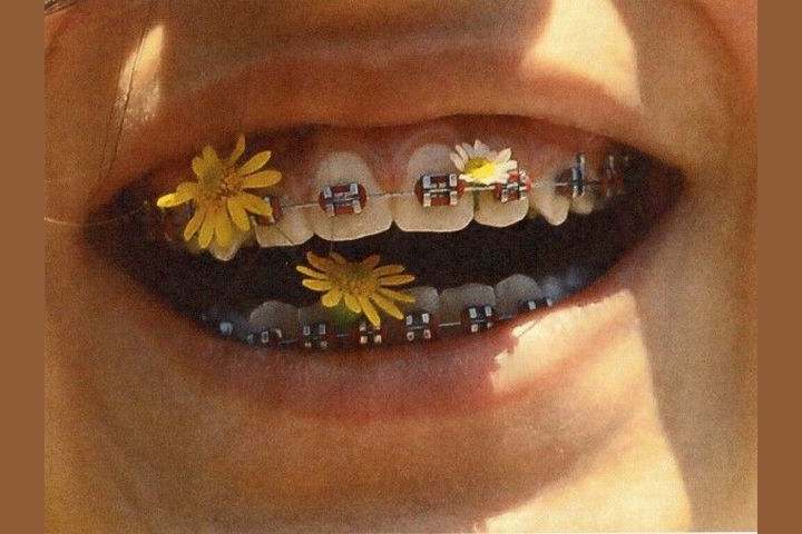 21 Struggles Anyone Who Had Braces As A Kid Will Remember We have some ideas for choosing the best braces colours for you. 21 struggles anyone who had braces as a