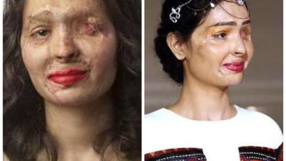Reshma Qureshi lost an eye and experienced severe burning and disfigurement in an acid attack two years ago, but now she's kicking off New York Fashion Week and standing up for acid victims everywhere.