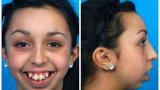 Ellie had a rare medical condition that was affecting the way she smiled, but after two surgeries, her smile and her future are both incredibly bright!
