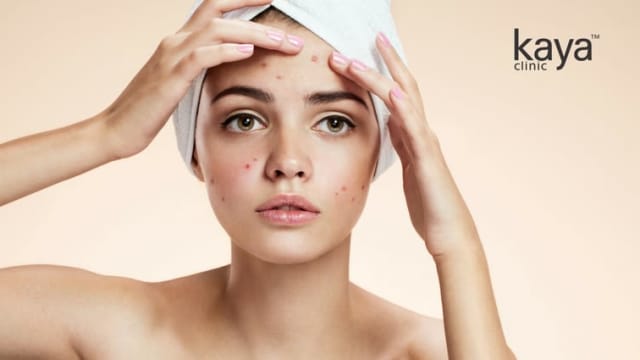 5 Golden Rules to follow this monsoon season to keep acne problems at bay.