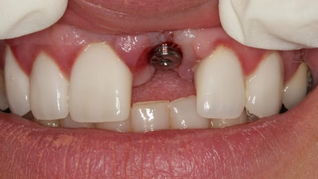 Dental implants are artificial tooth roots that provide a permanent base for fixed, replacement teeth. Compared to dentures, bridges and crowns, dental implants are a popular and effective long-term solution for people who suffer from missing teeth, failing teeth or chronic dental problems.