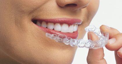Things to Know Before You Get Dental Braces