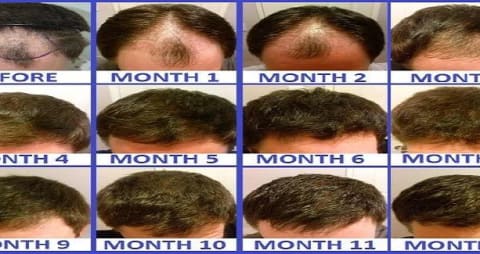 hair transplant timeline photos