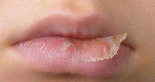 what-are-the-remedies-for-hives-and-eczema-on-the-lips