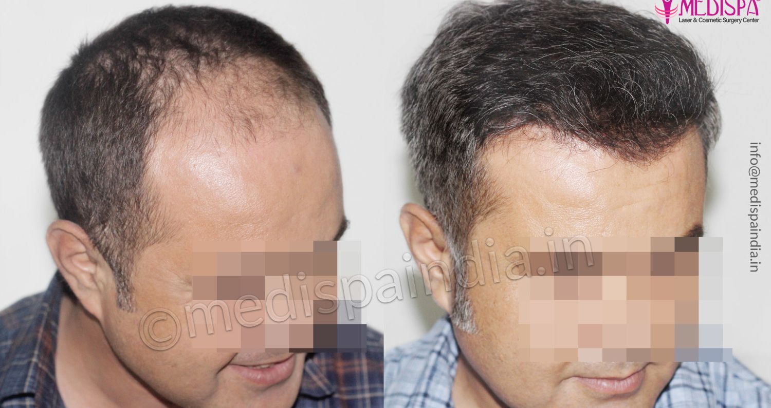 How To Avoid Common Hair Transplant Mistakes