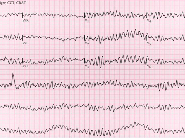 Do You Know Advanced Cardiovascular Life Support? | Playbuzz