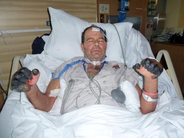 Un hombre en Oregon, EU, se recupera de la plaga en 2012.
