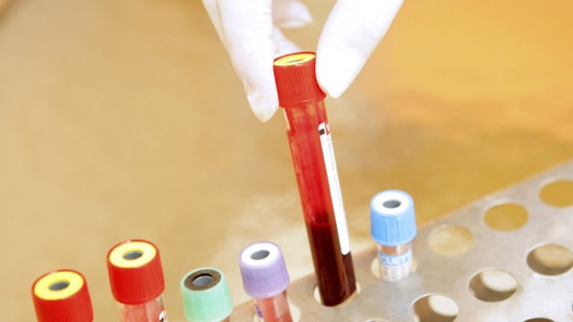 En España, investigadores  consiguieron  un gran avance para la lucha contra el VIH al lograr que el virus se volviera indetectable en la sangre y los tejidos de cinco pacientes que sobrevivieron al menos dos años tras el trasplante de células madre.